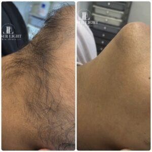 laser-hair-removal-east-london