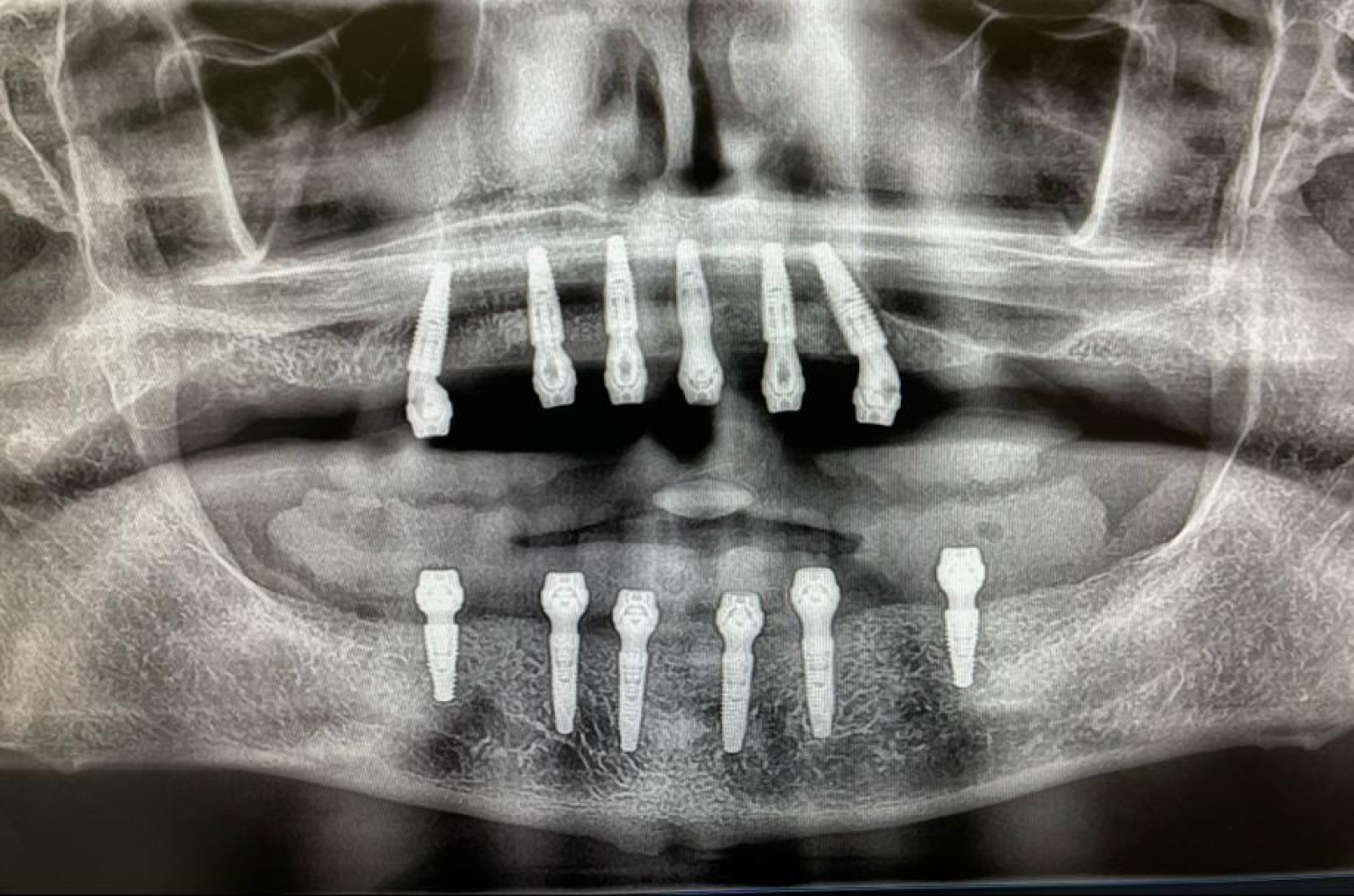 gum-surgery-in-tijuana