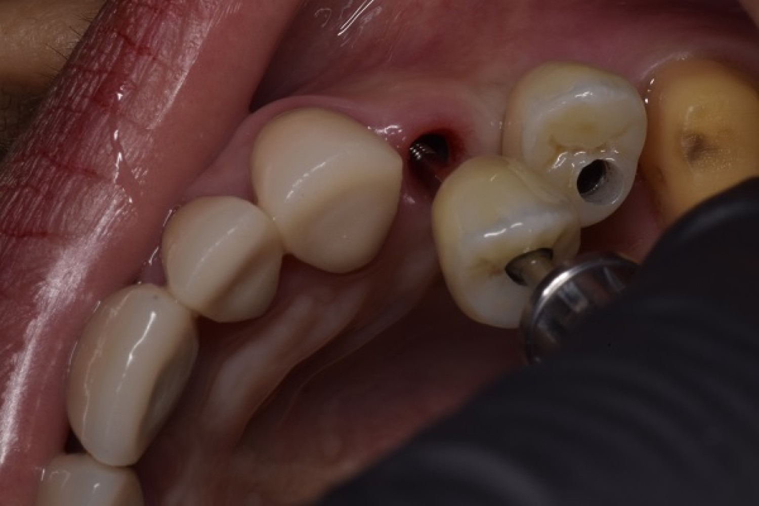 dental-implants-tijuana-offers-natural-looking-and-durable-teeth-replacements