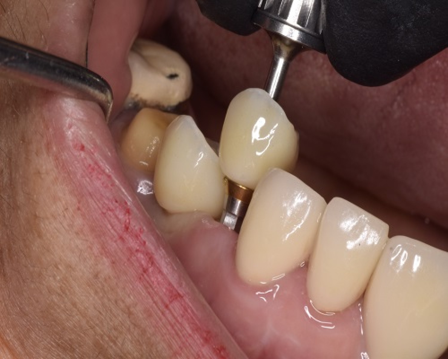 holistic-dentist-in-mexico-natural-biocompatible-care-for-your-health-and-smile