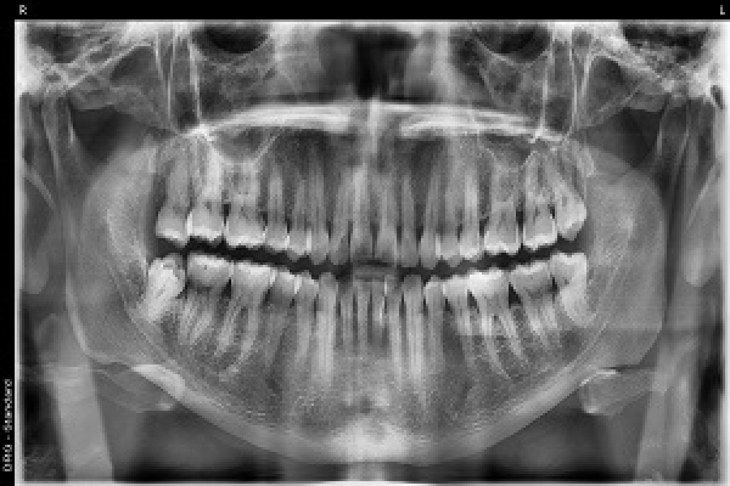 bring-back-your-true-smile-with-our-treatment-of-root-canal-in-tijuana