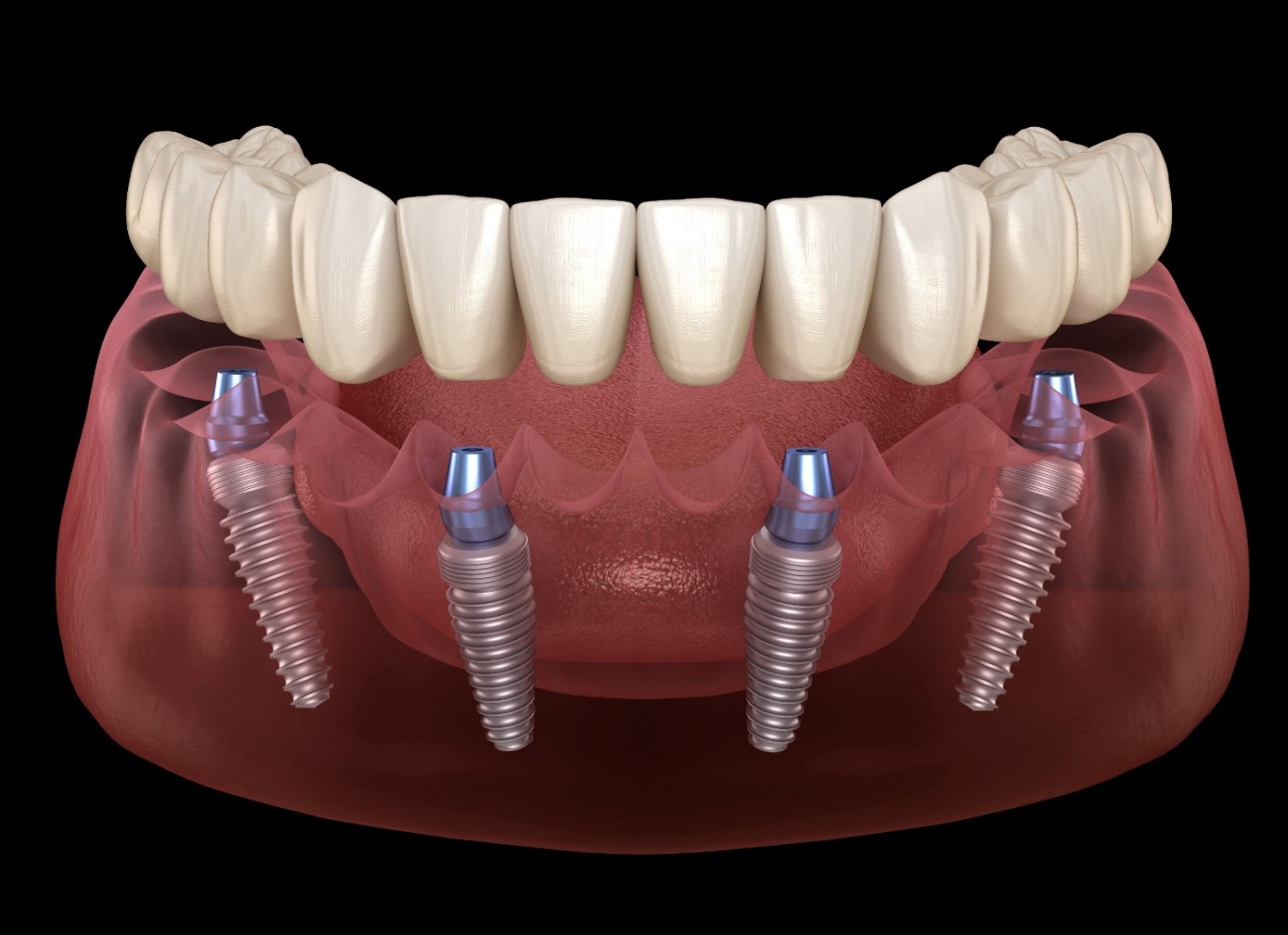 all-on-4-dental-implants-in-tijuana-mexico-affordable-life-changing-results