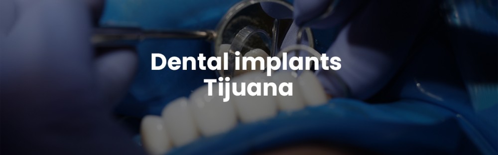 find-trustworthy-teeth-replacements-with-tijuana-dental-implants