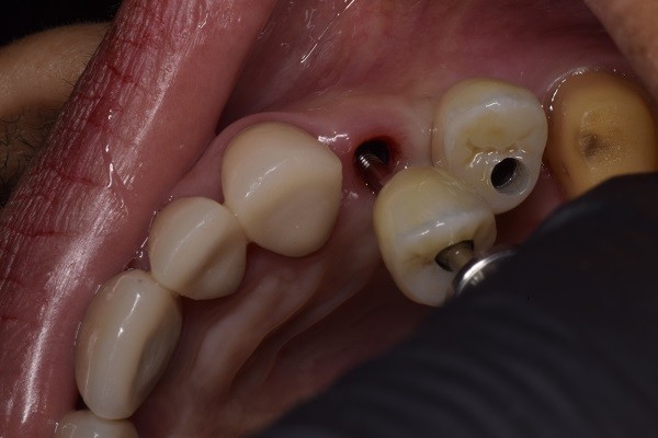 get-your-perfect-smile-by-treating-from-dentist-in-tijuana