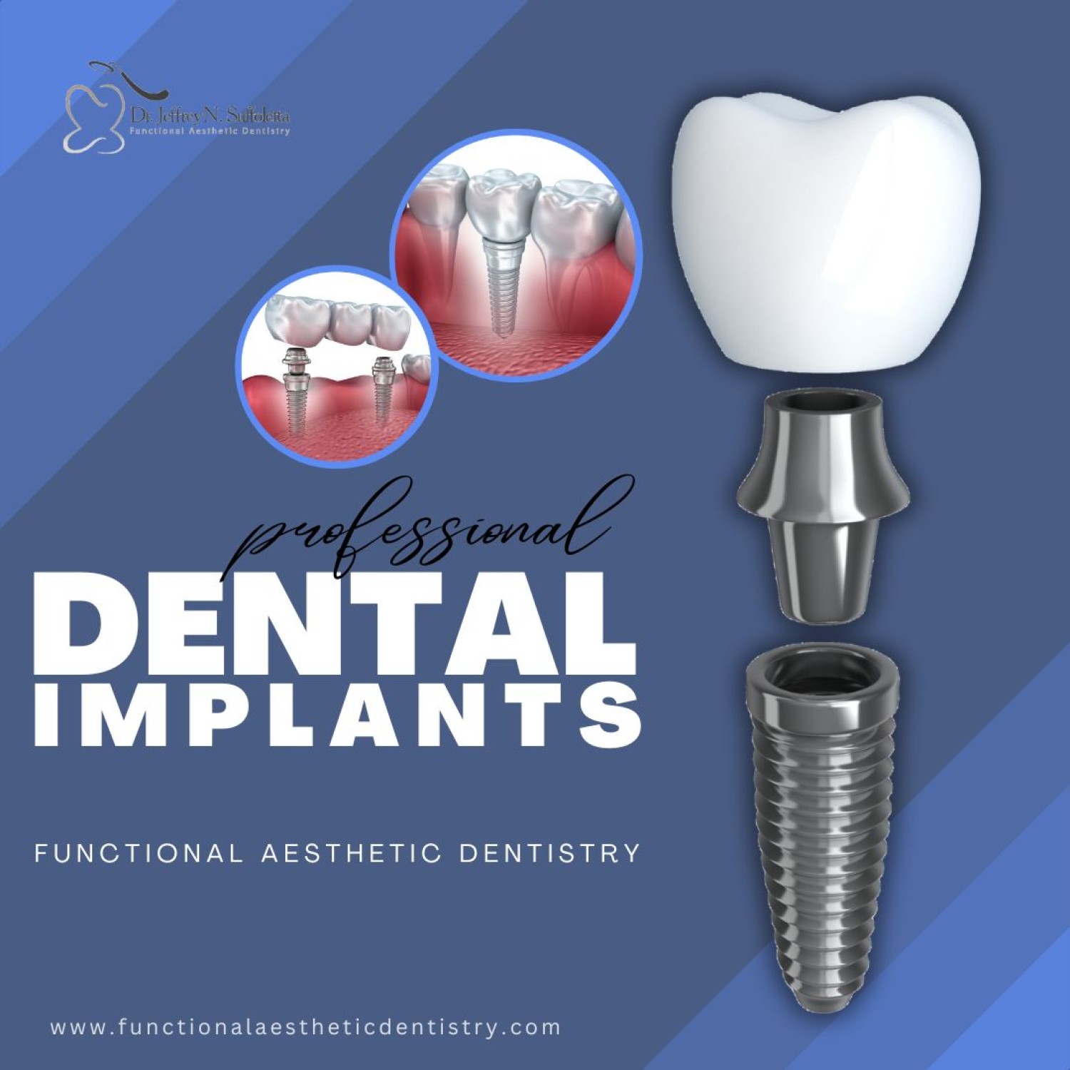 experience-superior-dental-implant-solutions-in-summerlin-at-functional-aesthetic-dentistry