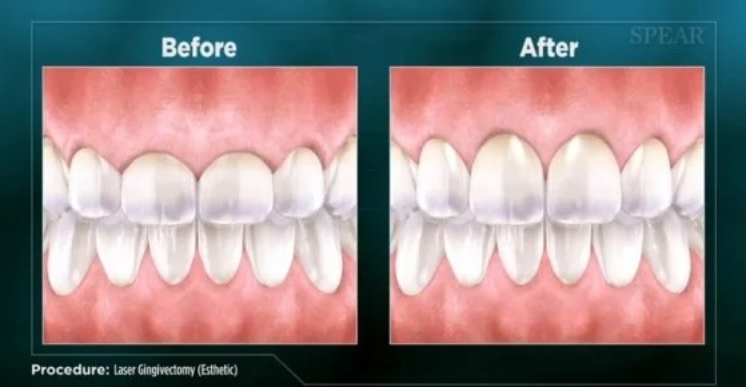 summerlin-dental-care-offers-advanced-laser-dentistry-that-can-transform-your-smile
