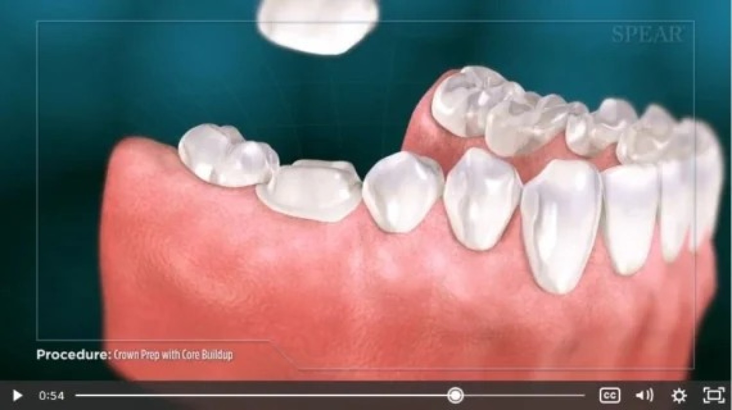 restore-your-smile-with-dental-implants-in-summerlin