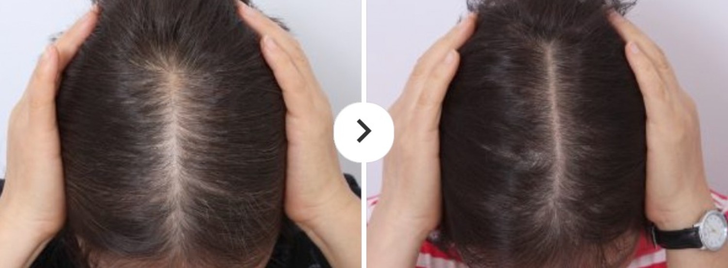 best-hairloss-treatment-dallas