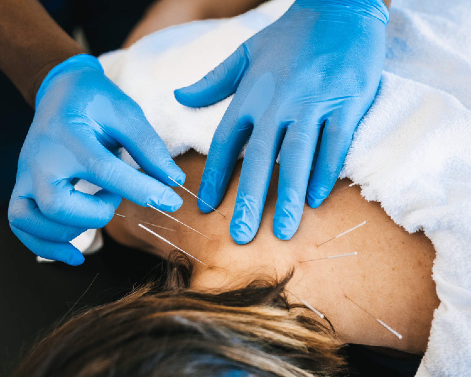 dry-needling-therapy-nyc